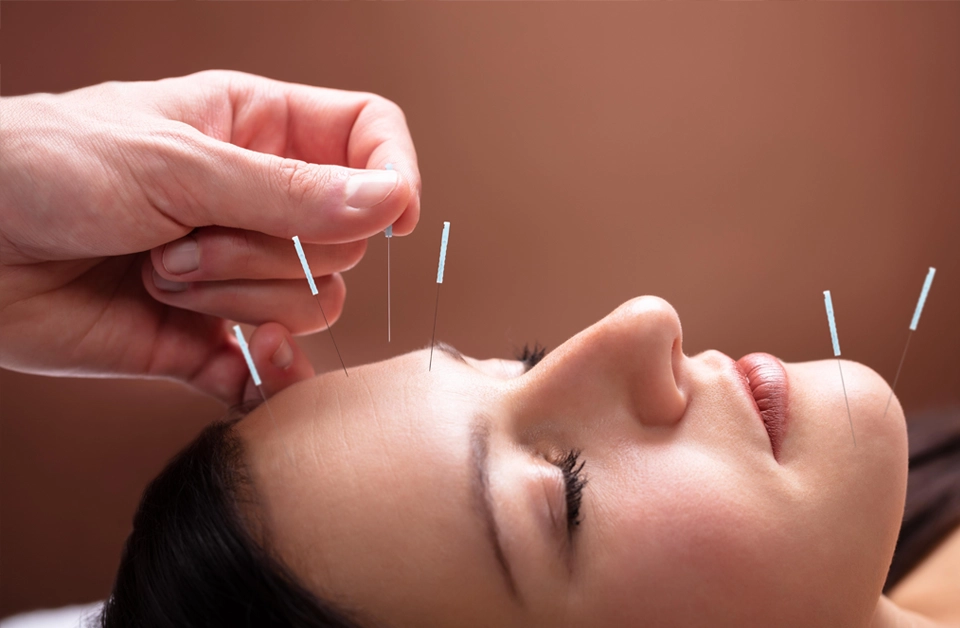 Someone getting facial acupuncture