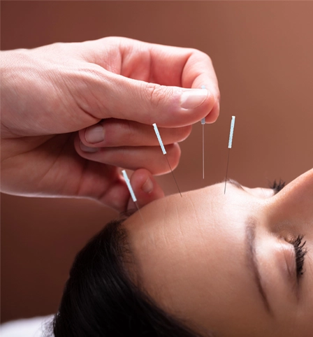 Someone getting facial acupuncture